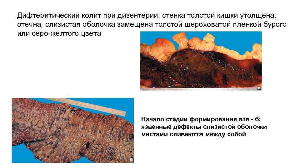 Дифтеритический колит при дизентерии: стенка толстой кишки утолщена, отечна, слизистая оболочка замещена толстой шероховатой