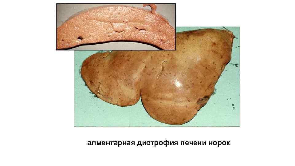 алментарная дистрофия печени норок 