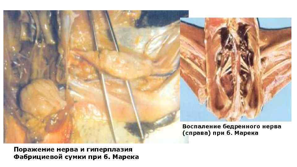 Воспаление бедренного нерва (справа) при б. Марека Поражение нерва и гиперплазия Фабрициевой сумки при