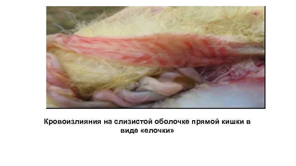 Кровоизлияния на слизистой оболочке прямой кишки в виде «елочки» 