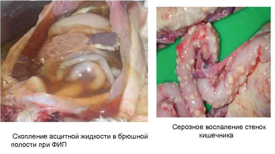  Скопление асцитной жидкости в брюшной полости при ФИП Серозное воспаление стенок кишечника 