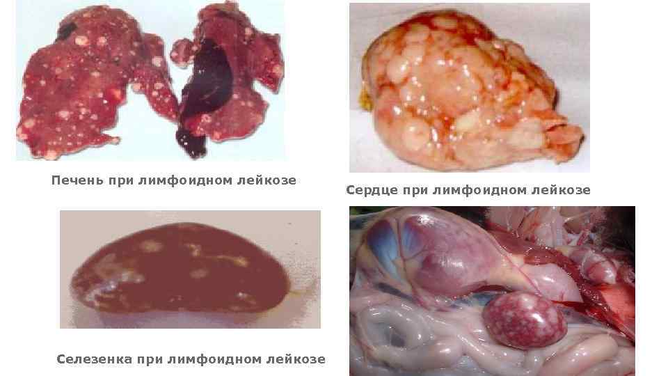 Печень при лимфоидном лейкозе Селезенка при лимфоидном лейкозе Сердце при лимфоидном лейкозе 