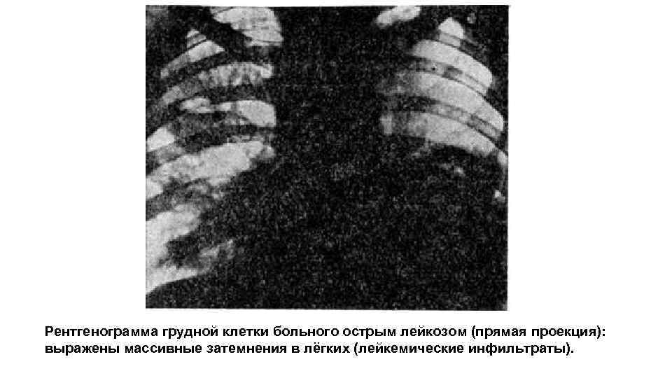 Рентгенограмма грудной клетки больного острым лейкозом (прямая проекция): выражены массивные затемнения в лёгких (лейкемические