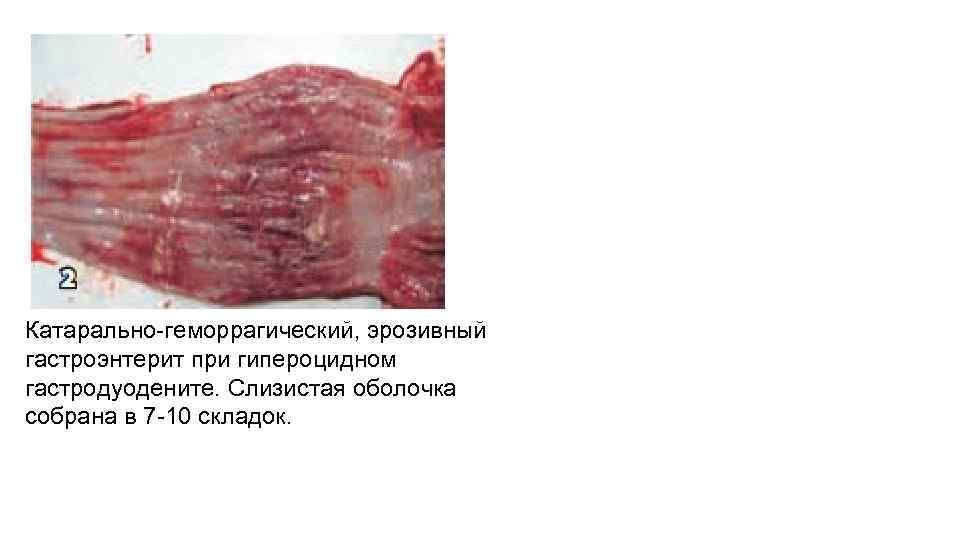 Катарально-геморрагический, эрозивный гастроэнтерит при гипероцидном гастродуодените. Слизистая оболочка собрана в 7 -10 складок. 