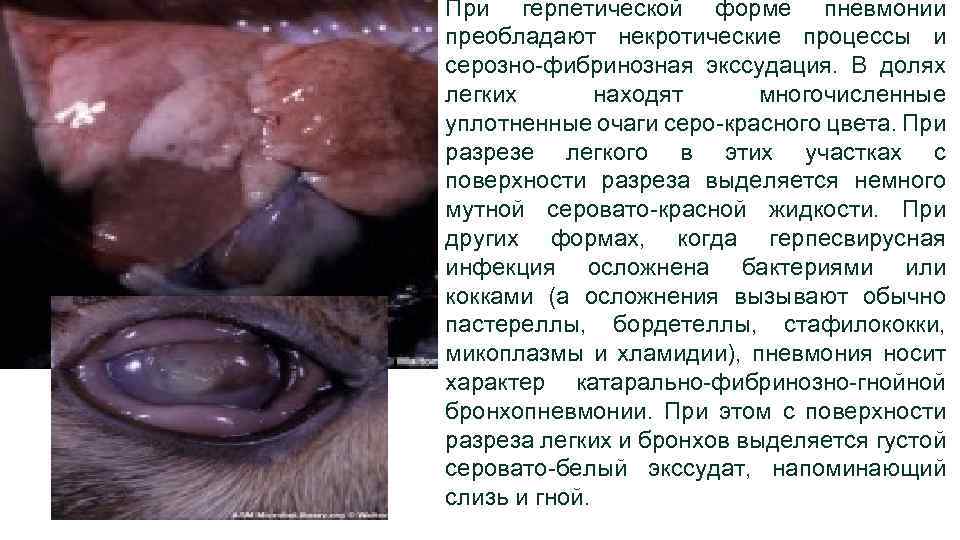 При герпетической форме пневмонии преобладают некротические процессы и серозно-фибринозная экссудация. В долях легких находят