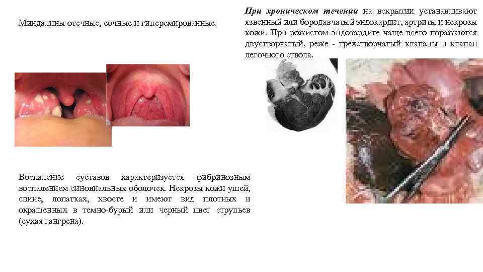 Миндалины отечные, сочные и гиперемированные. При хроническом течении на вскрытии устанавливают язвенный или бородавчатый