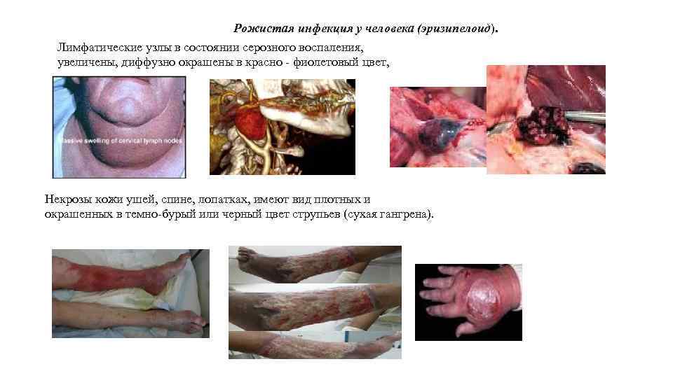 Рожистая инфекция у человека (эризипелоид). Лимфатические узлы в состоянии серозного воспаления, увеличены, диффузно окрашены