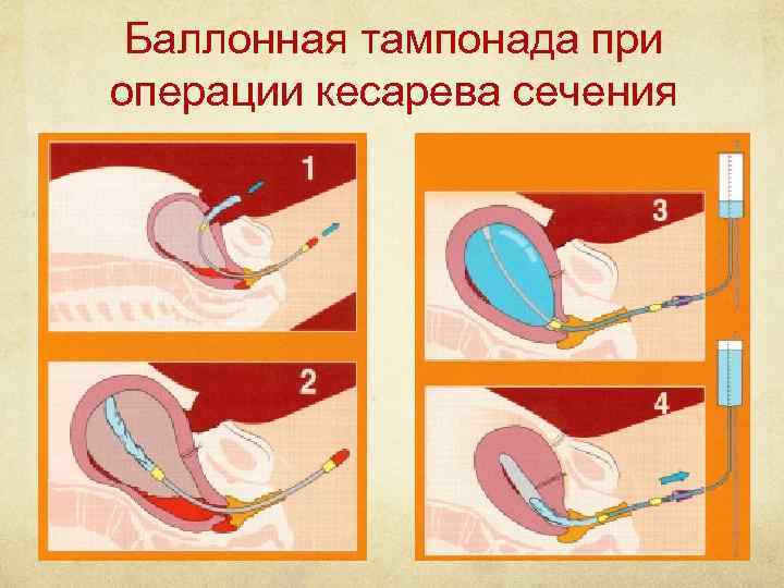 Баллонная тампонада при операции кесарева сечения 