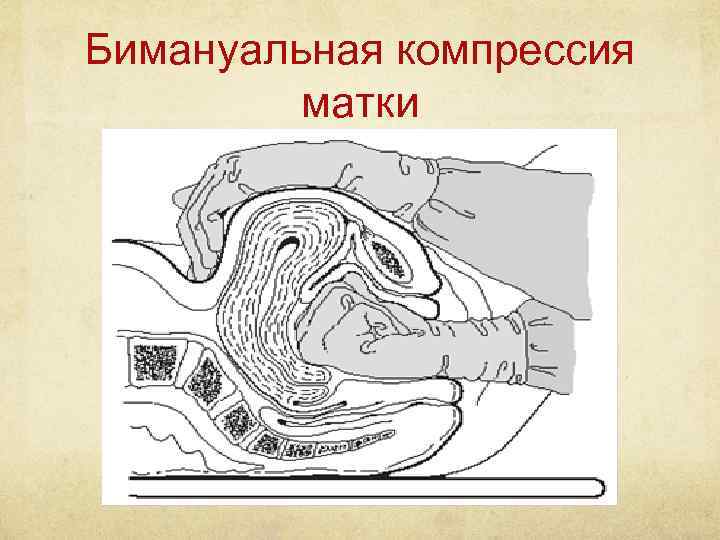 Бимануальная компрессия матки 