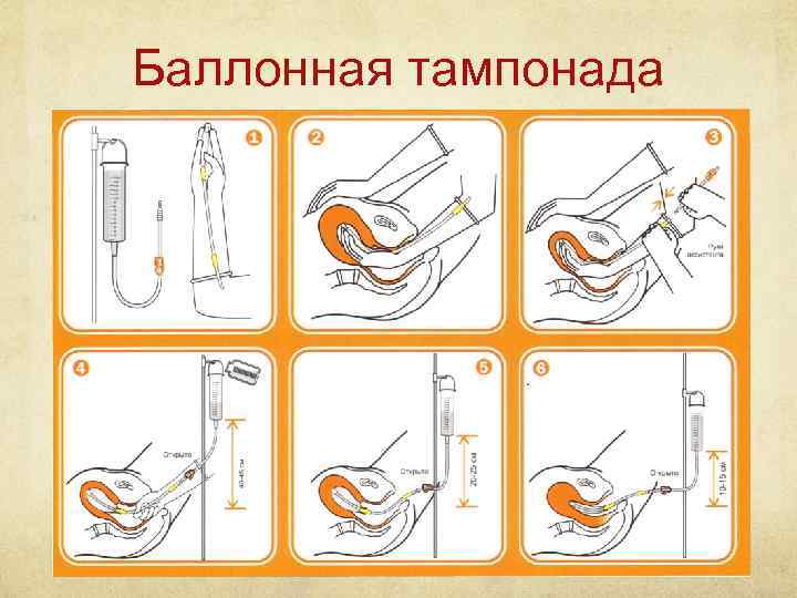 Баллонная тампонада 
