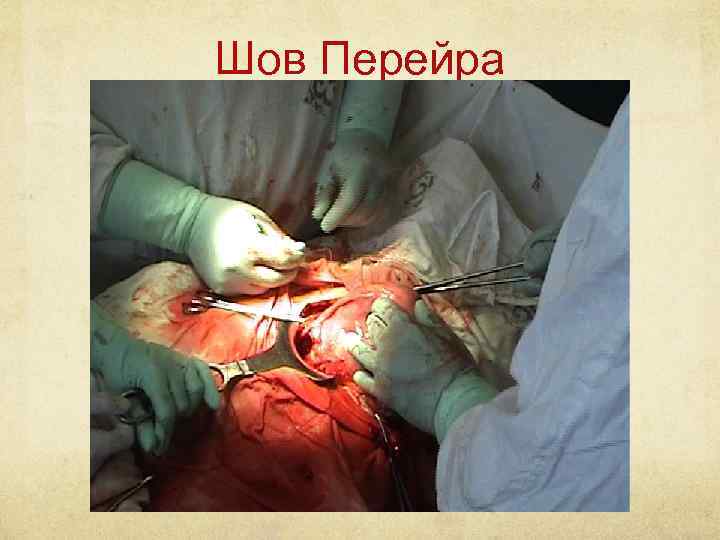 Шов Перейра 