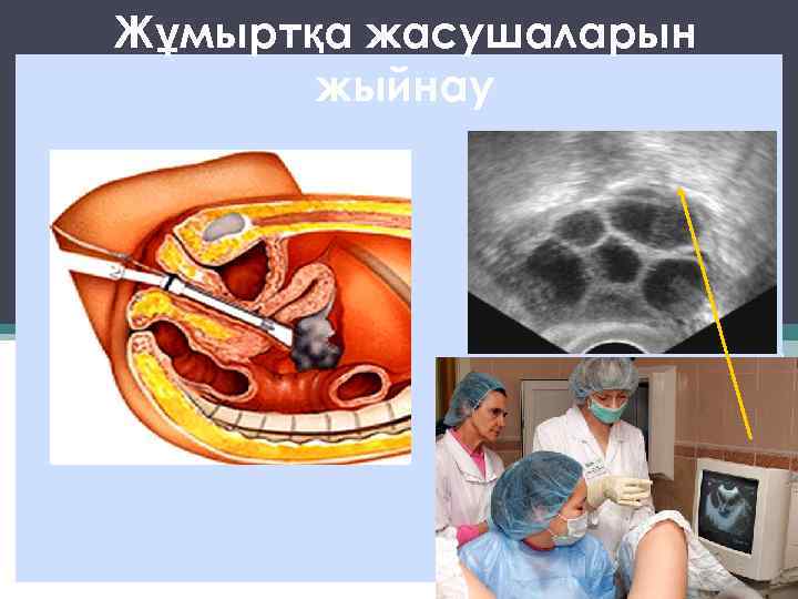 Жұмыртқа жасушаларын жыйнау 