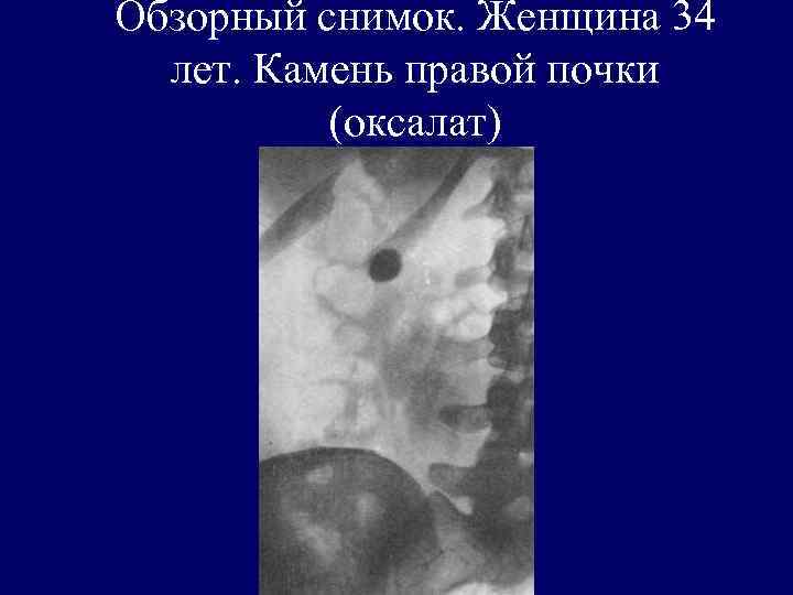 Обзорный снимок. Женщина 34 лет. Камень правой почки (оксалат) 