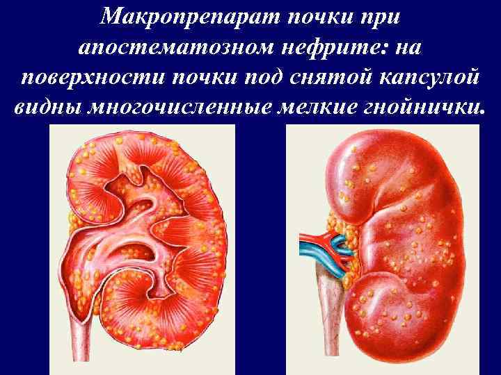 Макропрепарат почки при апостематозном нефрите: на поверхности почки под снятой капсулой видны многочисленные мелкие