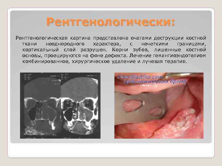 Для рентгенологической картины фолликулярной кисты характерна деструкция костной ткани