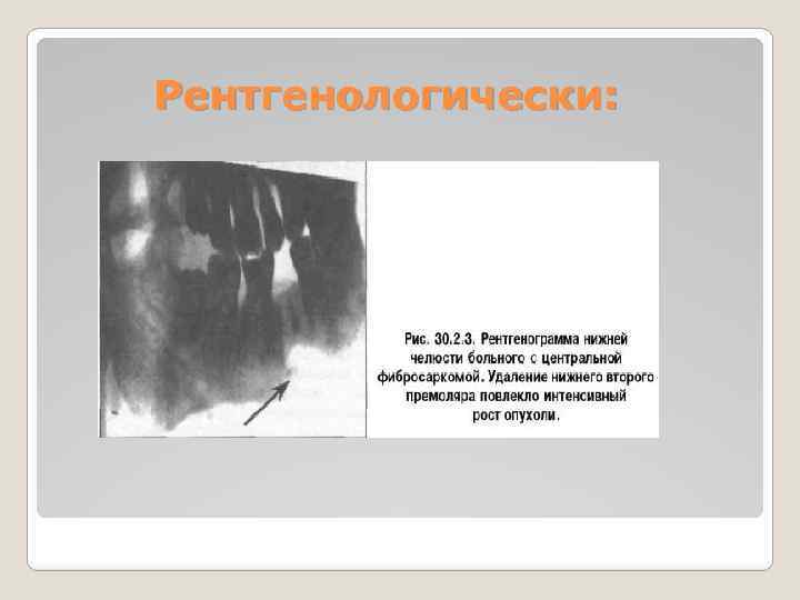 Рентгенологически: 