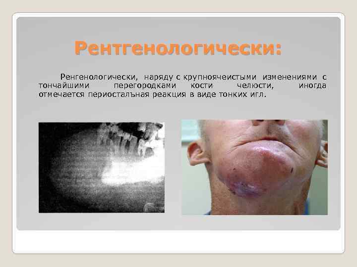 Рентгенологически: Ренгенологически, наряду с крупноячеистыми изменениями с тончайшими перегородками кости челюсти, отмечается периосталъная реакция