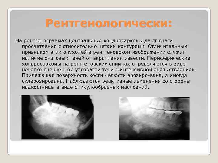 Клиническая картина при остеогенной саркоме в начале заболевания выражается следующими признаками