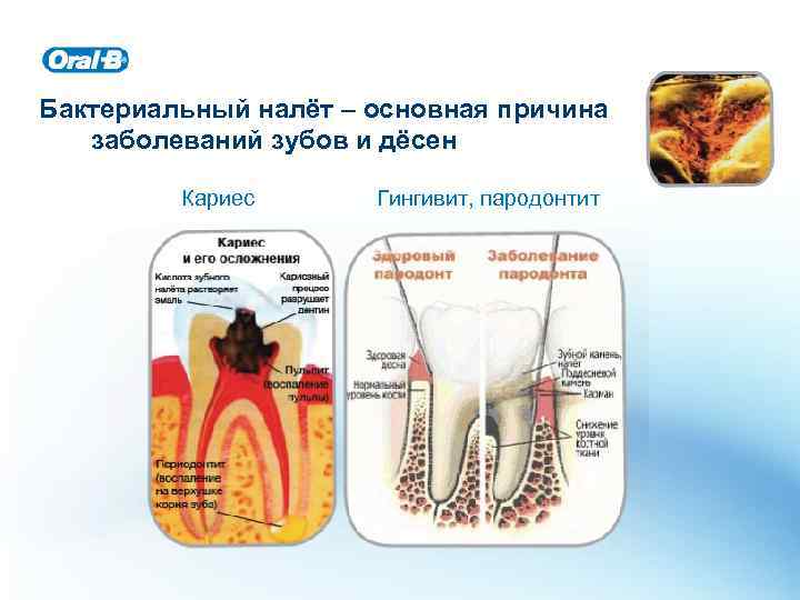 Бактериальный налёт – основная причина заболеваний зубов и дёсен Кариес Гингивит, пародонтит 