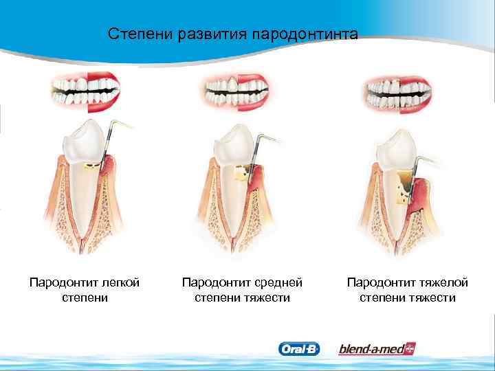 Степени развития пародонтинта Пародонтит легкой степени Пародонтит средней степени тяжести Пародонтит тяжелой степени тяжести