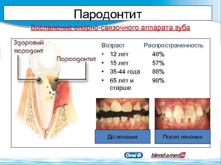 Пародонтит Воспаление опорно-связочного аппарата зуба Возраст Распространенность • 12 лет 48% • 15 лет