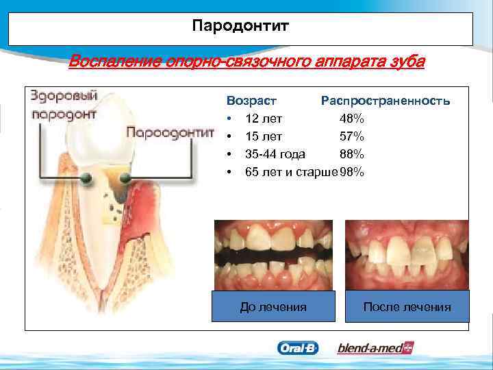 Пародонтит лечение