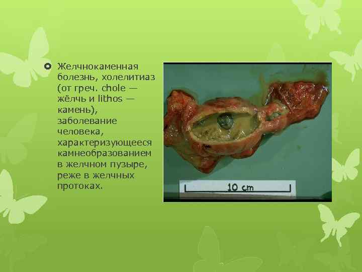  Желчнокаменная болезнь, холелитиаз (от греч. chole — жёлчь и lithos — камень), заболевание