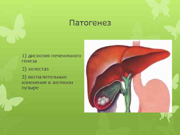 Патогенез 1) дисхолия печеночного генеза 2) холестаз 3) воспалительные изменения в желчном пузыре 