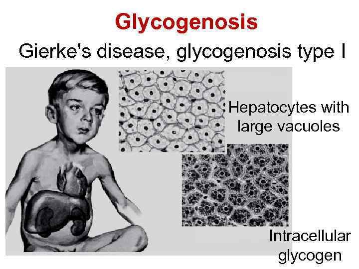 Glycogenosis Gierke's disease, glycogenosis type I Hepatocytes with large vacuoles Intracellular glycogen 