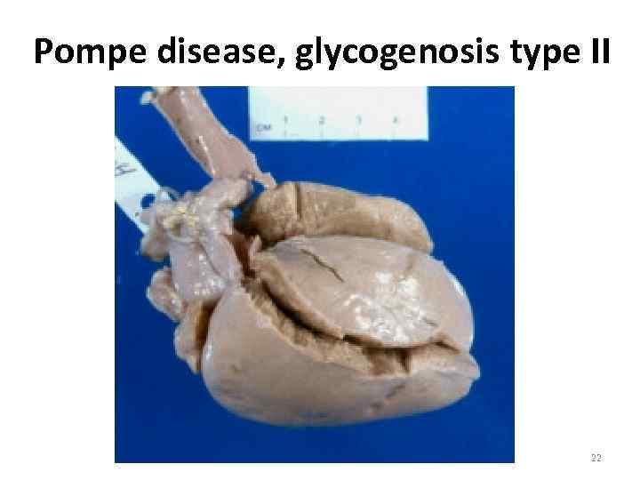 Pompe disease, glycogenosis type II 22 