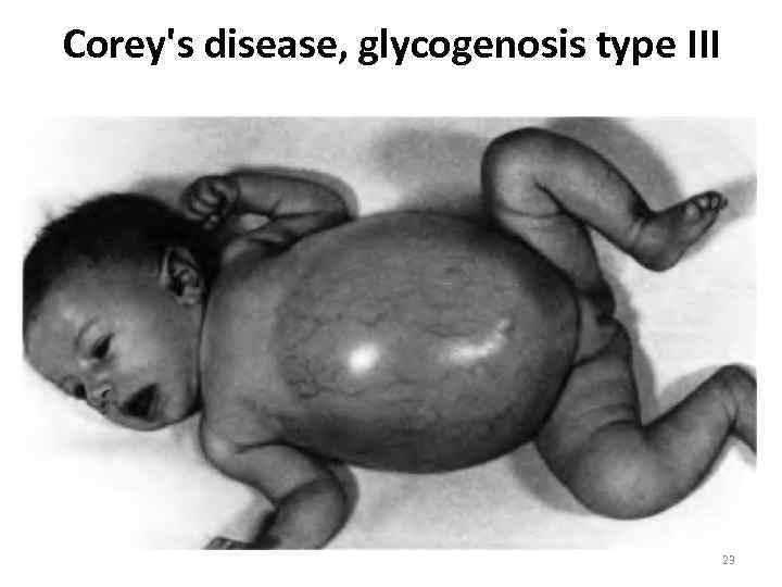 Corey's disease, glycogenosis type III 23 