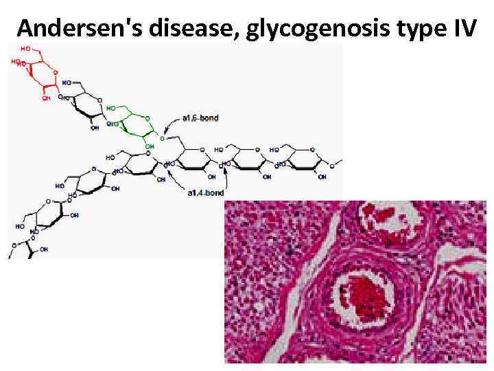 Andersen's disease, glycogenosis type IV 24 