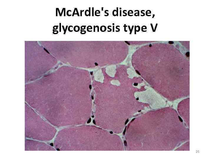 Mc. Ardle's disease, glycogenosis type V 25 