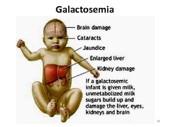 Galactosemia 48 