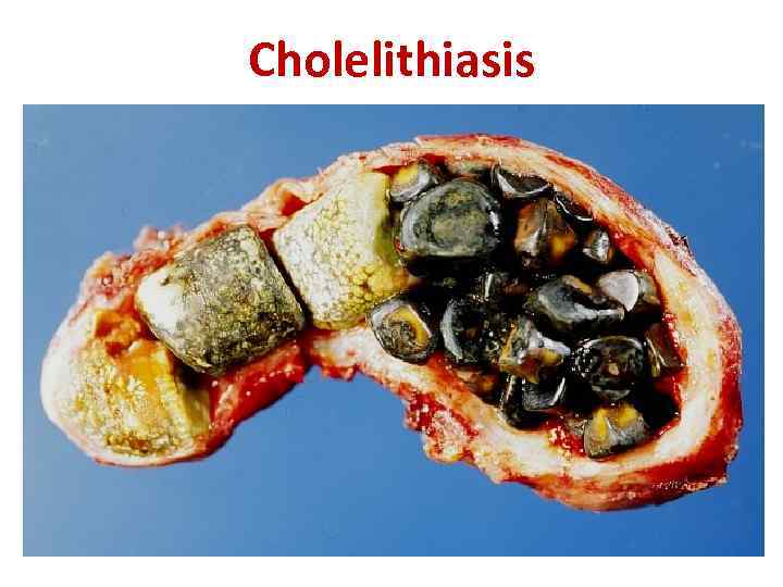 Cholelithiasis 