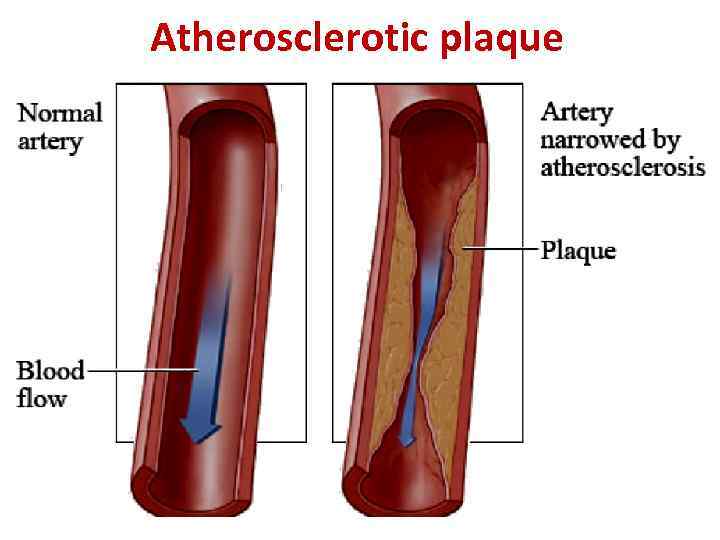 Atherosclerotic plaque 