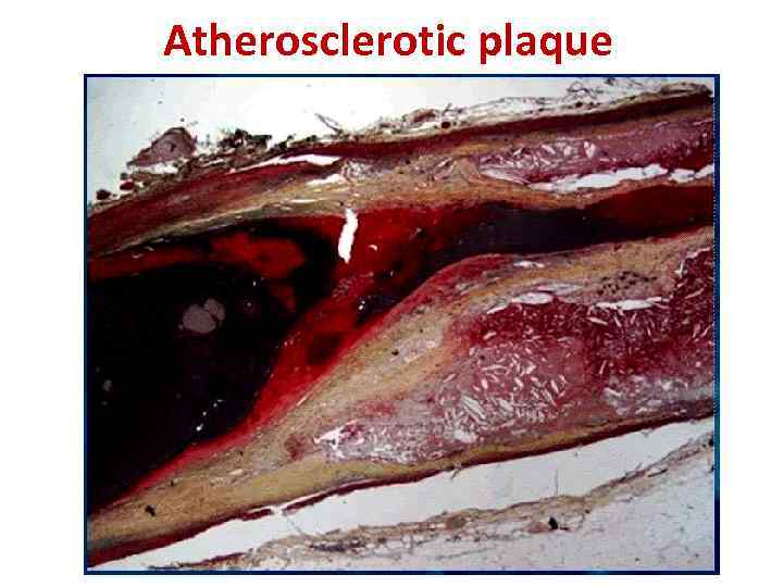 Atherosclerotic plaque 