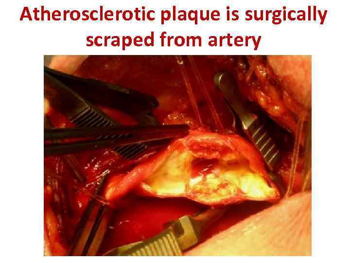 Atherosclerotic plaque is surgically scraped from artery 