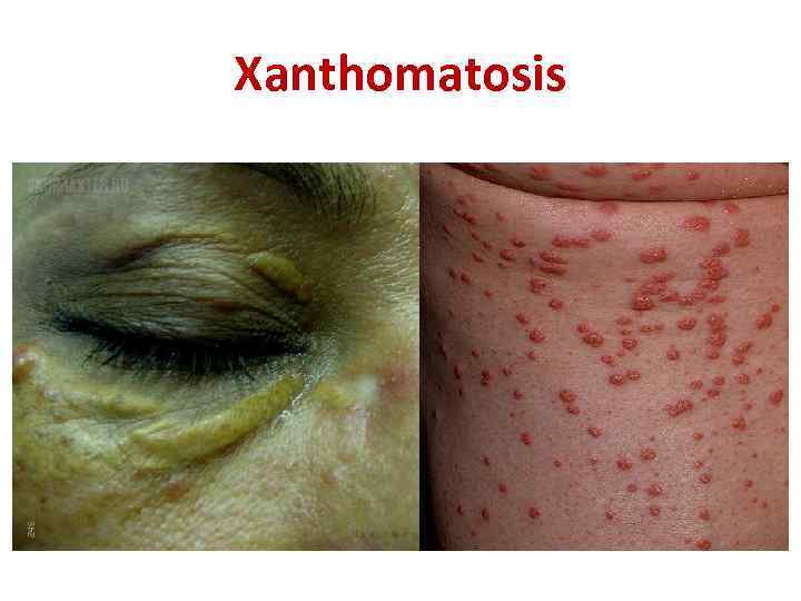 Xanthomatosis 