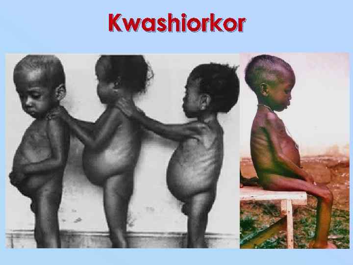 Kwashiorkor 