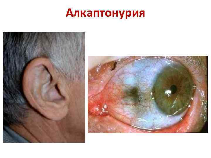 Алкаптонурия 
