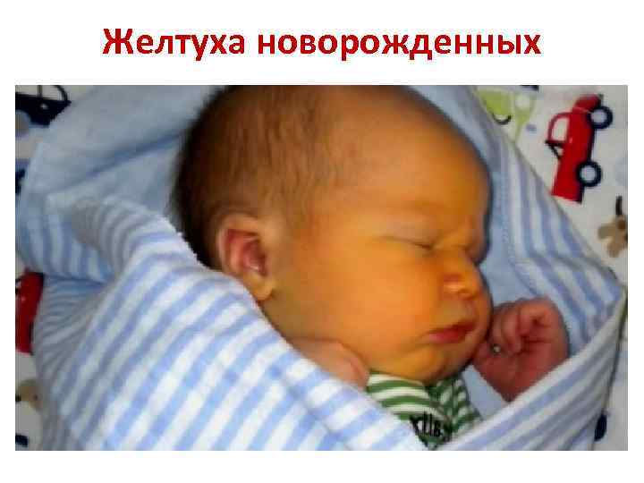 Желтуха новорожденных 
