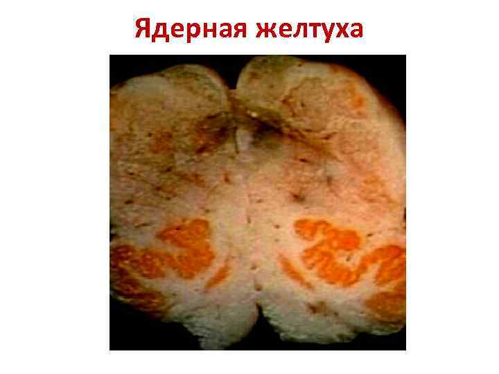 Ядерная желтуха 