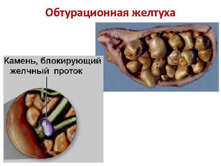 Обтурационная желтуха 