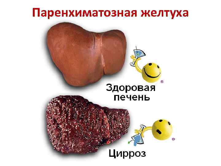 Паренхиматозная желтуха 