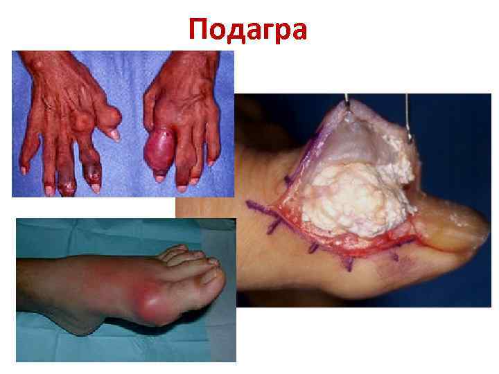 Подагра 