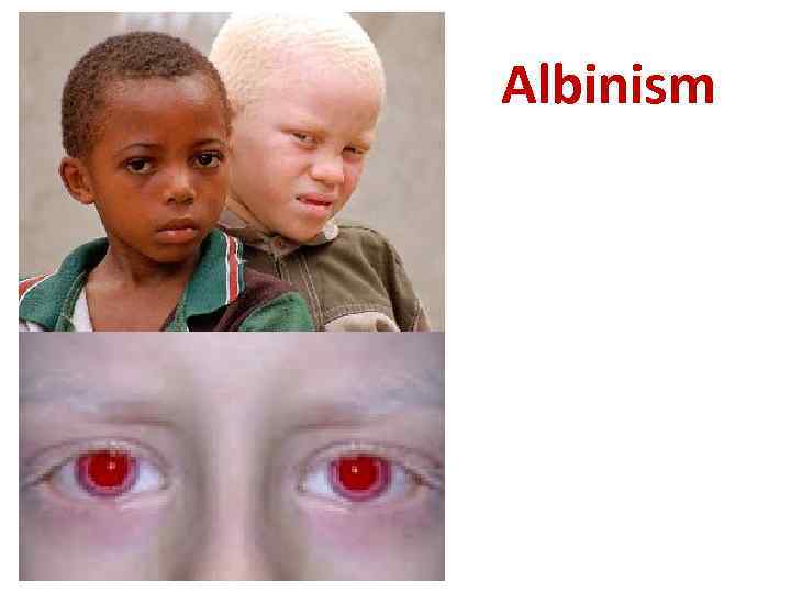 Albinism 