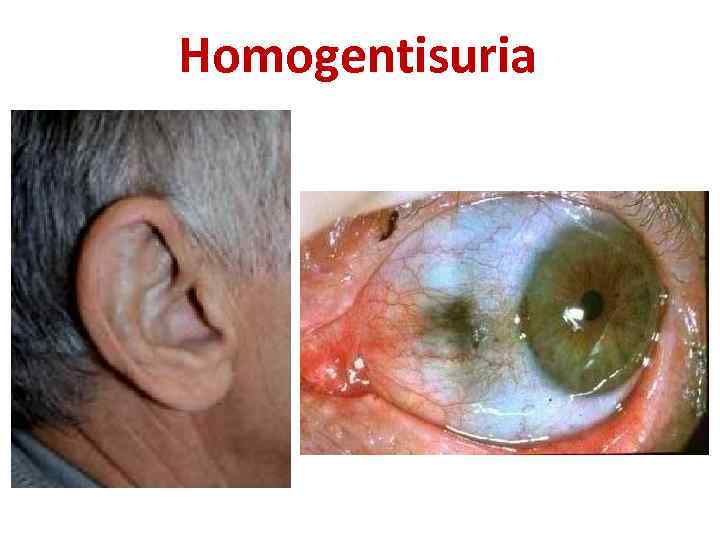 Homogentisuria 