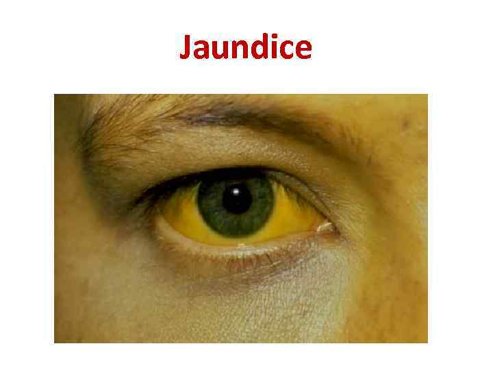 Jaundice 