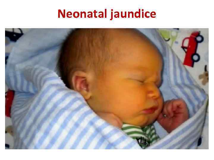 Neonatal jaundice 